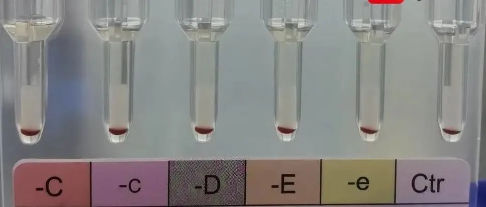 江苏发现2例全球罕见黄金血型！该血型全球不足50例，国内报道仅4例